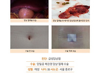 급성담낭염수술후기. 지긋..