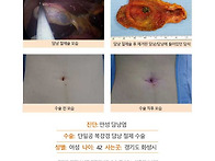 만성담낭염수술후기. 단일..