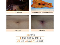 담석증수술후기. 원장님께..