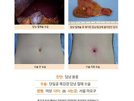 담낭용종수술후기. 후기가..
