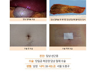 담낭선근종증수술후기. 인..