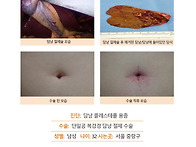 담낭콜레스테롤용종수술후..