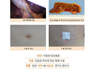 다발성담낭용종수술후기. ..