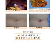 담낭용종수술후기. 해외에..