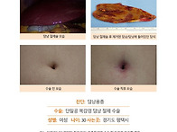 담낭용종수술후기. 담낭 ..