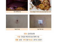 급성담낭염수술후기. 담석..