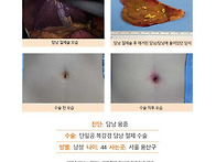 담낭용종수술후기. 수술은..