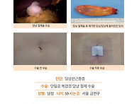 담낭선근종증수술후기. 김..