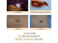 담낭선근종증수술후기. 몇..
