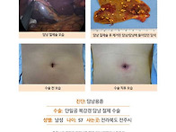 담낭용종수술후기. 유튜브..