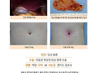 담낭용종수술후기. 담낭제..