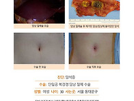 담석증수술후기. 담석 크기..