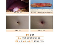담석증수술후기. 김정윤 ..
