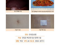 만성담낭염수술후기. 과식..