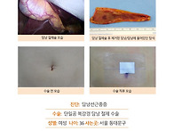 담낭선근종증수술후기. 담..