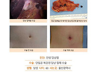 만성담낭염수술후기. 평소..