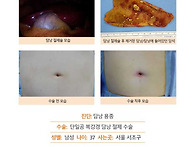 담낭용종수술후기. 매우 ..