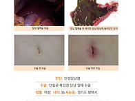 만성담낭염수술후기. 담석..