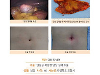 급성담낭염수술후기. 원장..