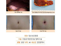 담낭선근종증수술후기. 너..