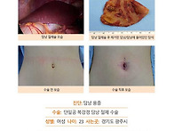 담낭용종수술후기. 건강검..