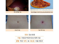 담낭절제수술후기. 건강검..