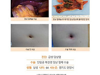 급성담낭염수술후기. 너무..