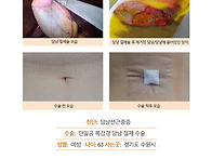 담낭선근종증수술후기. 원..