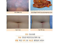 담낭용종수술후기. 수술에..