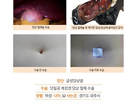 급성담낭염수술후기. 원장..