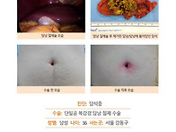 담석증수술후기. 수술 전,..
