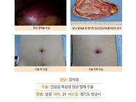 담석증수술후기. 배에 구멍..