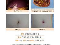 담낭콜레스테롤용종수술후..