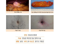 담낭선근종증수술후기. 김..