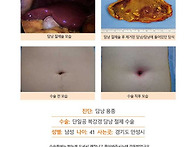 담낭용종수술후기. 담낭에..