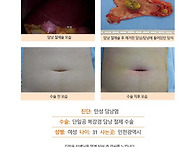 만성담낭염수술후기. 수술..
