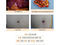 만성담낭염수술후기. 주변..