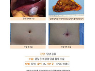 담낭용종수술후기. 담낭에..