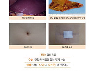 담낭용종수술후기. 지난 ..