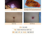 담낭용종수술후기. 대학병..