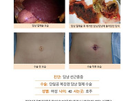 담낭선근종증수술후기. 매..