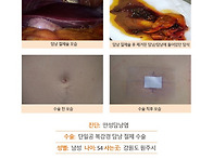 만성담낭염수술후. 김정윤..