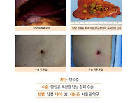 담석증수술후기. 꽤 오랜시..