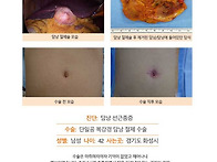 담낭선근종증수술후기. 급..