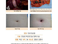 만성담낭염수술후기. 작은..