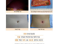 만성담낭염수술후. 몇 년 ..