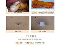 담낭용종수술후기. 매년 ..