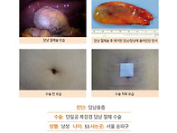 담낭용종수술후기. 원장님..