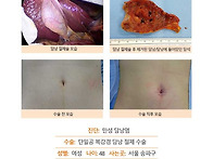 만성담낭염수술후기. 수술..