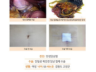 만성담낭염수술후기. 진료..